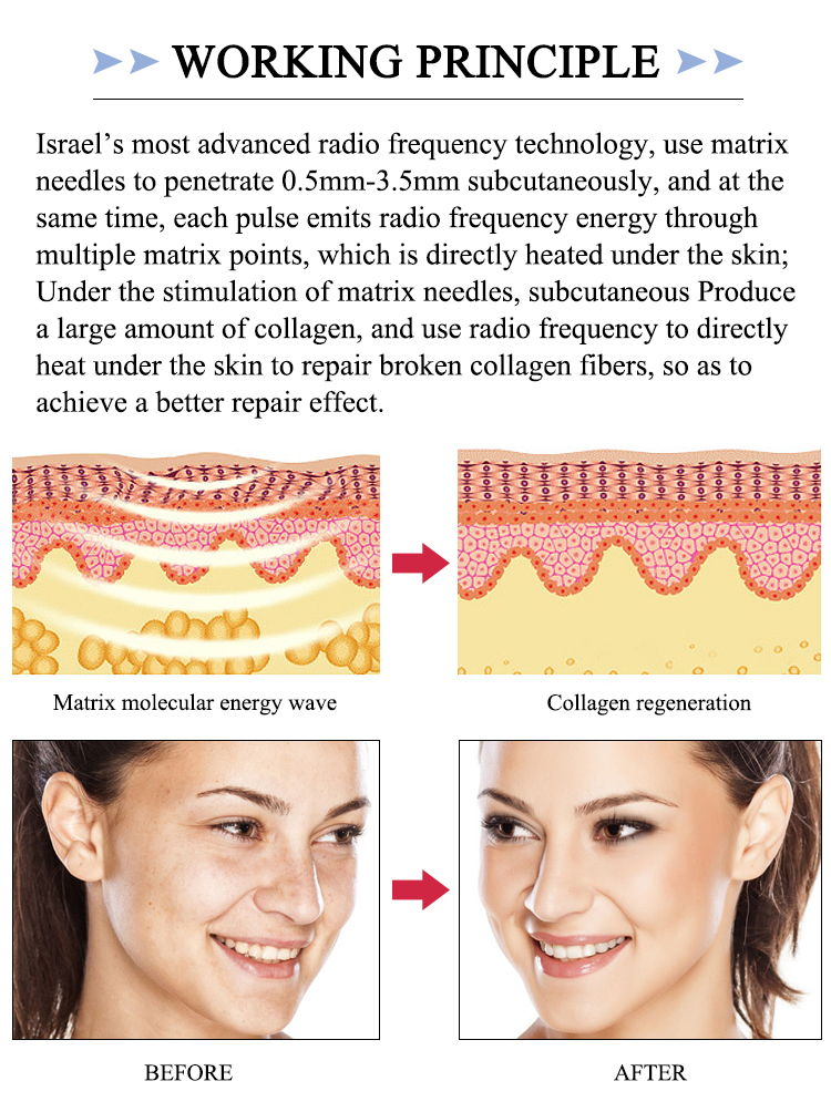 Gold RF Microneedle (DT-806)