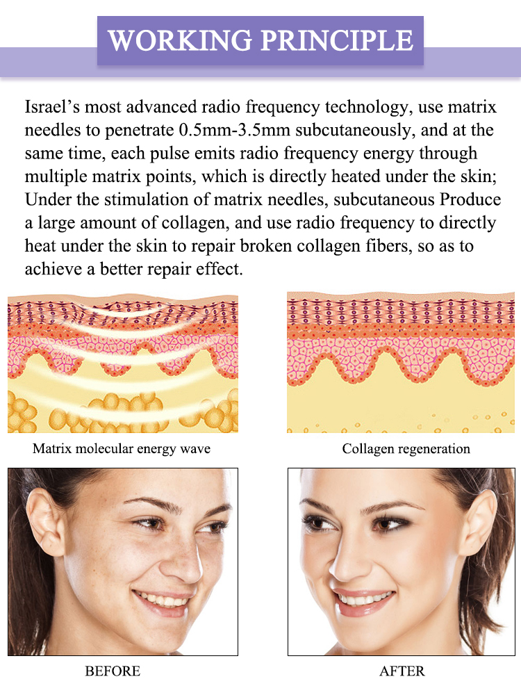 Gold RF Microneedle (DT-816)