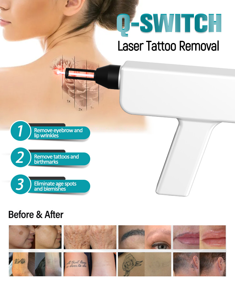 IPL+Q-Switch (2 in 1)