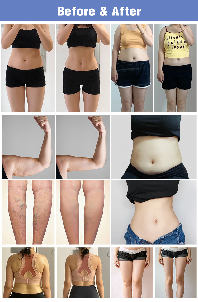 Shock Wave 3 in 1 SWTLIPO