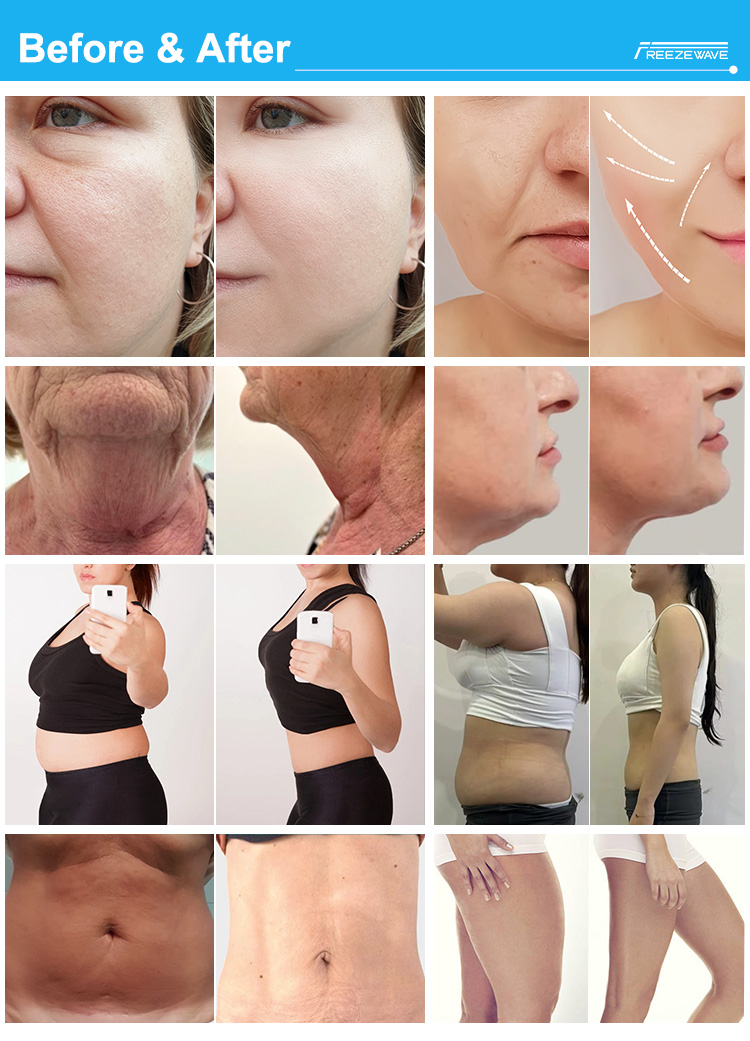 Coolwave Body Shape (DT-85)