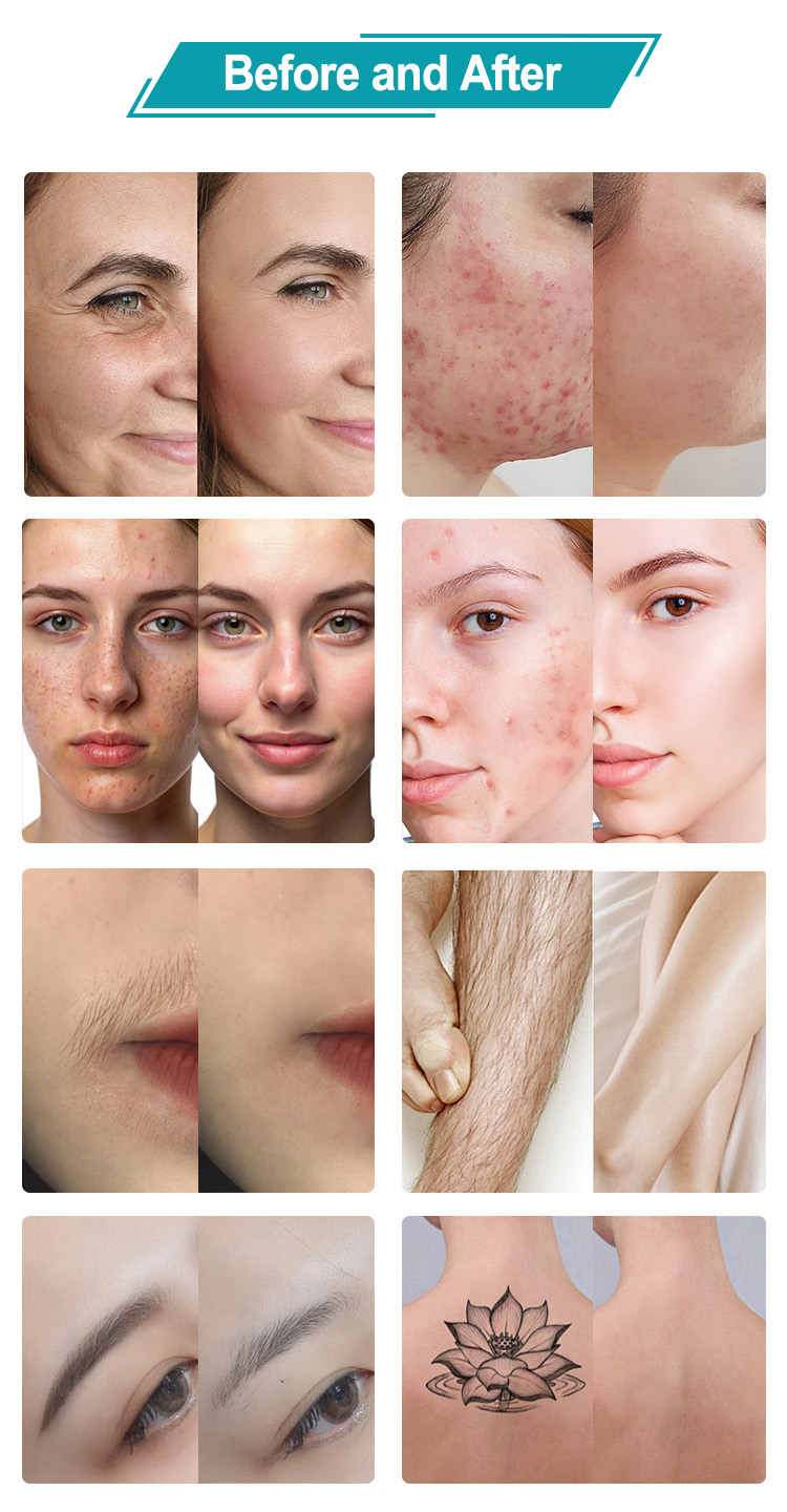IPL+Q-Switch+Diode Laser (3 in 1)