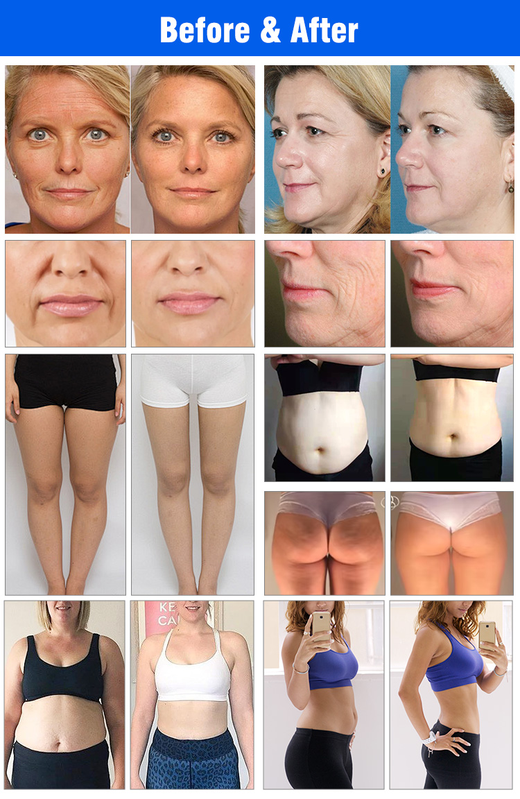 Body Shape Slimming (DT-V39)